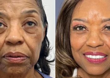 I paid $102,000 for a facelift at 71. I wish I could have done it a decade ago, but I couldn’t afford it.