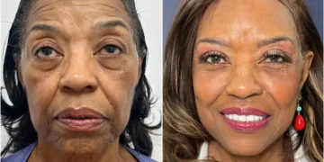 I paid $102,000 for a facelift at 71. I wish I could have done it a decade ago, but I couldn’t afford it.