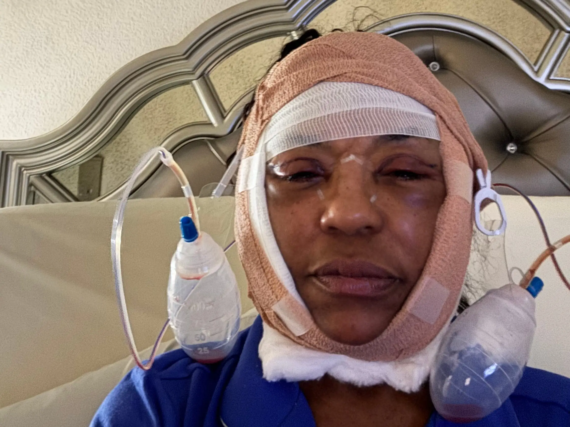 A woman wearing bandages after a facelift.