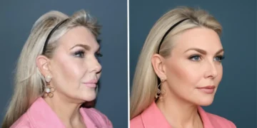 AI face is taking over — and driving plastic surgeons crazy