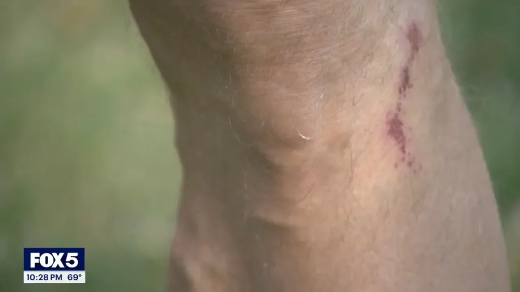 Collins said he sustained road rash on his shoulder, elbow and knee and was treated by paramedics who were called to the scene.