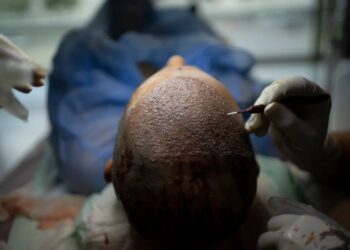 How Turkey Hacked the Hair Transplant Industry