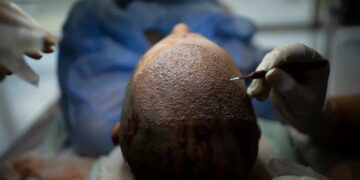 How Turkey Hacked the Hair Transplant Industry