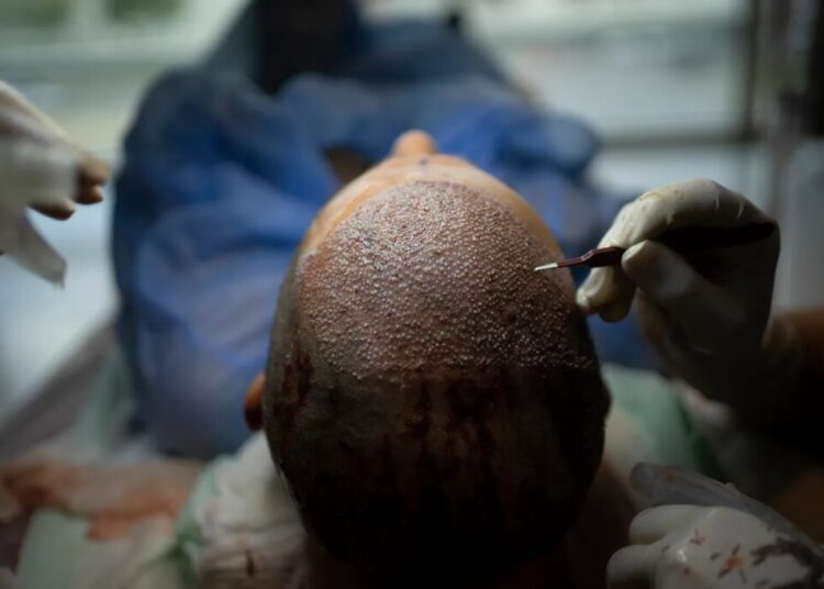 How Turkey Hacked the Hair Transplant Industry