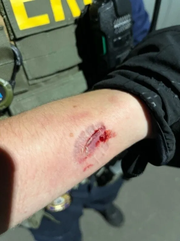 A federal law enforcement officer shows off the bloody bite mark left after a protester allegedly bit the agent during a protest outside Delaney Hall in Newark, NJ. 