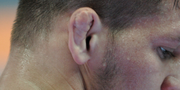 Men Are Paying to Give Themselves Cauliflower Ear to Look Like MMA Fighters