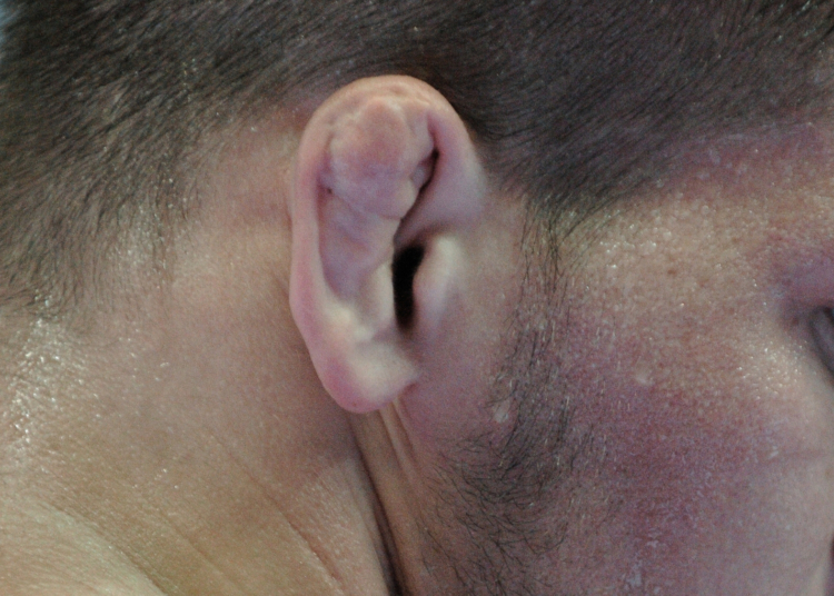 Men Are Paying to Give Themselves Cauliflower Ear to Look Like MMA Fighters
