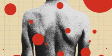 The Backward Logic of Chickenpox Parties