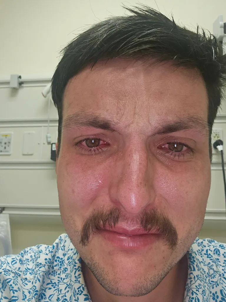 A man with red, teary eyes and a red nose, showing signs of having been pepper-sprayed.