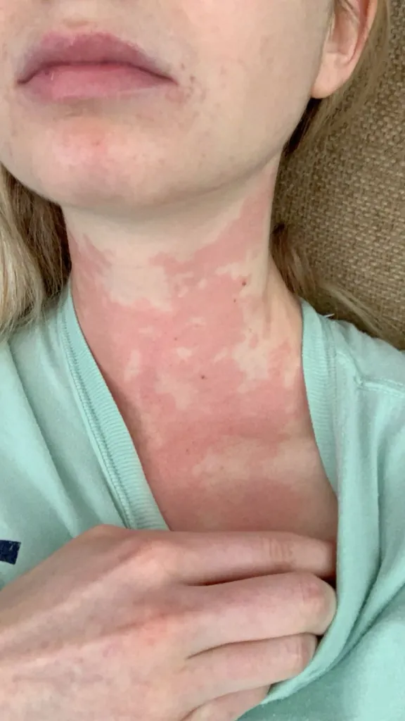 Caroline Cray's neck and chest are covered in red, blotchy skin.