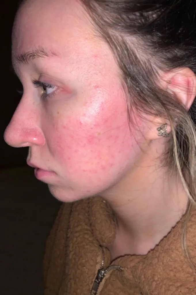 A close-up side profile of Jenna Lee Jane's face showing red, inflamed skin with small bumps, consistent with an autoimmune disease flare-up.