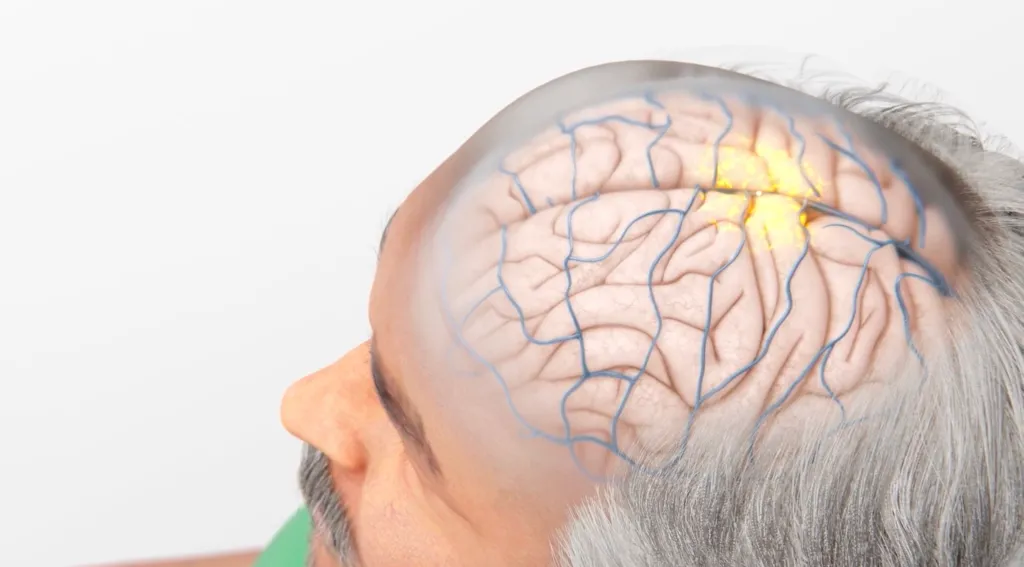 Illustration of a brain with an implant, glowing yellow at the insertion point, inside a person's head.