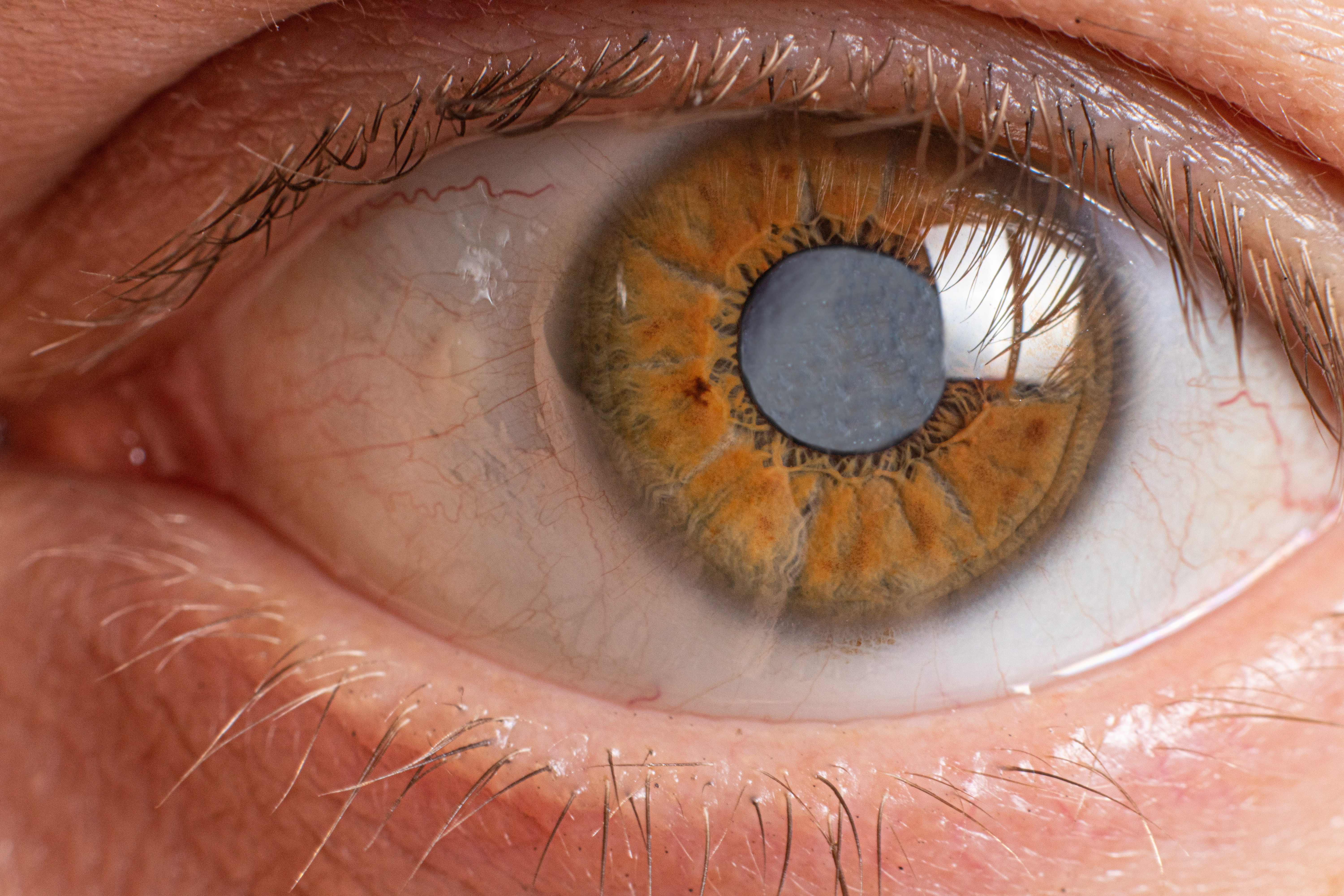 According to the Mayo Clinic, a cataract is the clouding of the lens of the eye.