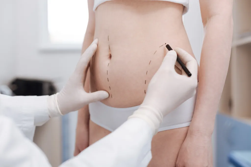 Gloved hands of a medical professional drawing dashed lines on a patient's abdomen for liposuction.