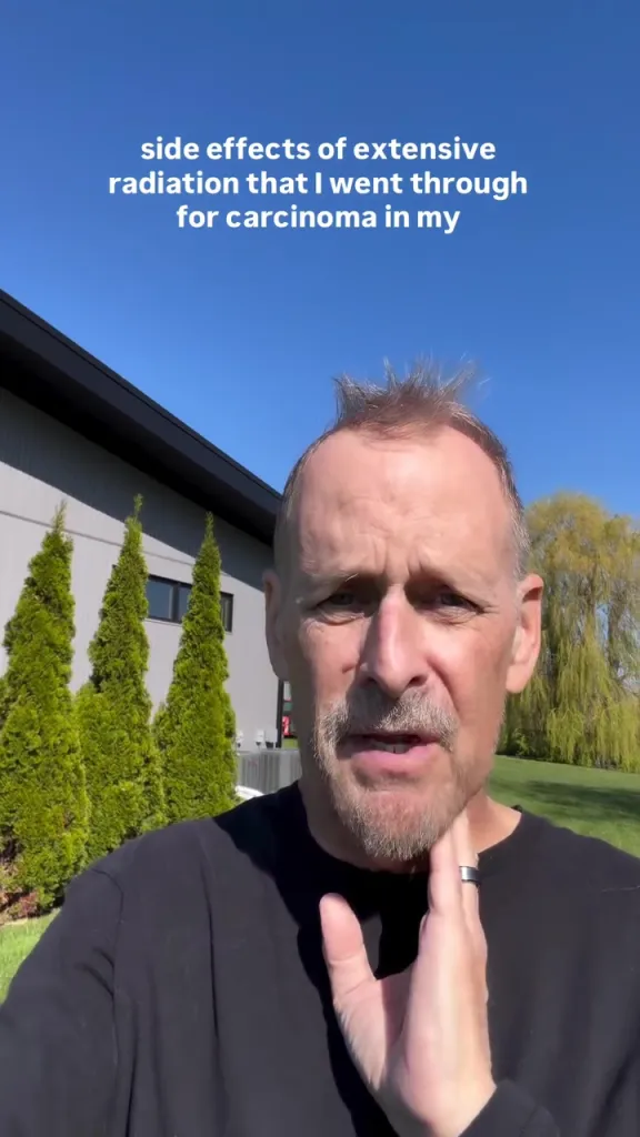 Dave Coulier discussing the side effects of extensive radiation for carcinoma.