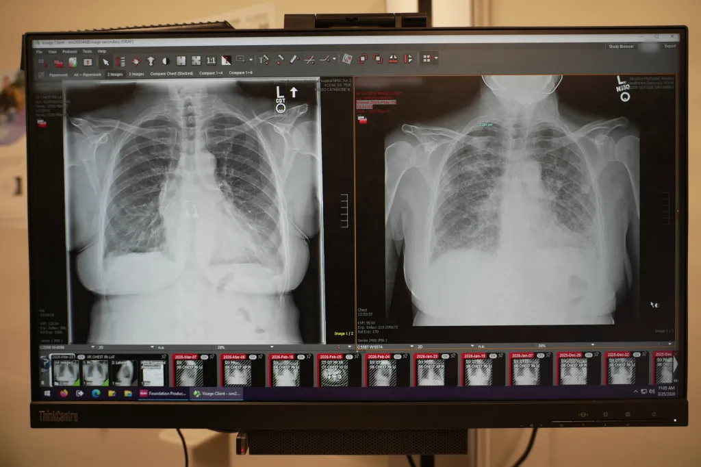 Medical display showing two chest X-rays, comparing Jodi Graf's new lungs (left) to her old lungs (right).