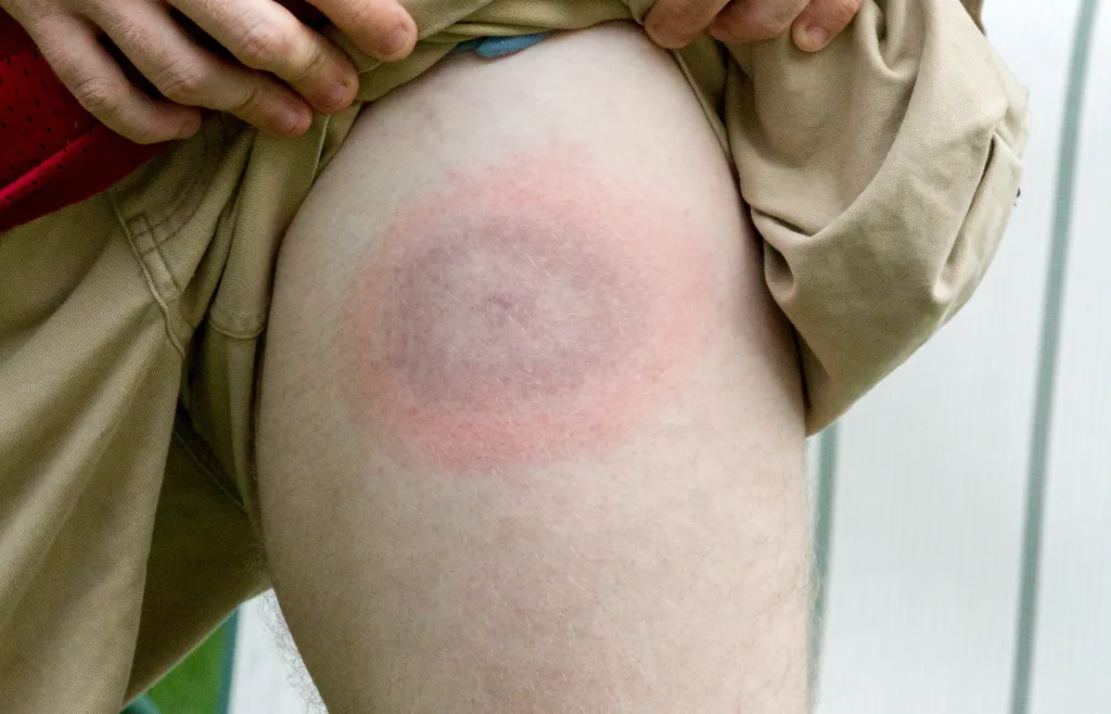 Steven's upper leg displays a bullseye rash characteristic of Lyme disease.