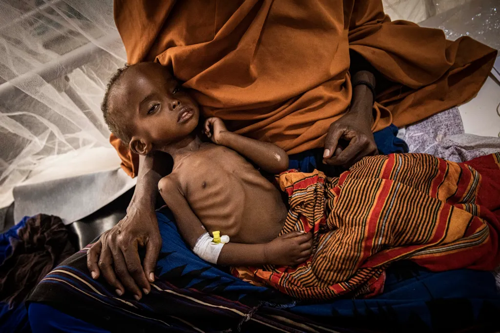 A severely malnourished baby lies on a mother's lap, with their ribs clearly visible and an IV line in their arm.