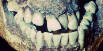 A Neanderthal Tooth Proved Ancient Dentistry Existed, and It Was Absolutely Brutal