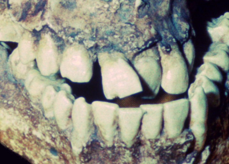 A Neanderthal Tooth Proved Ancient Dentistry Existed, and It Was Absolutely Brutal