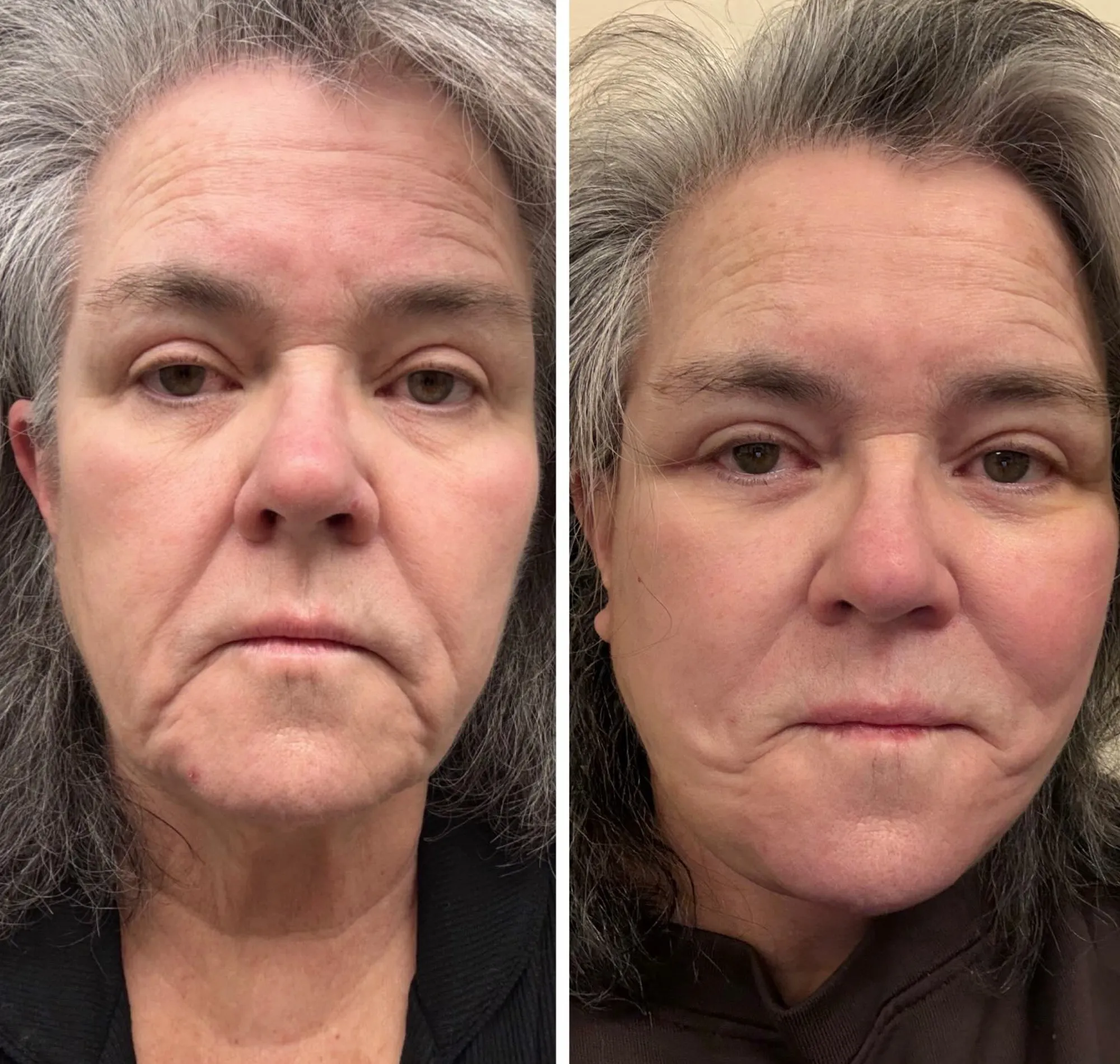 Collage of two close-up photos of Rosie O'Donnell's face, showing her before and after a facelift.