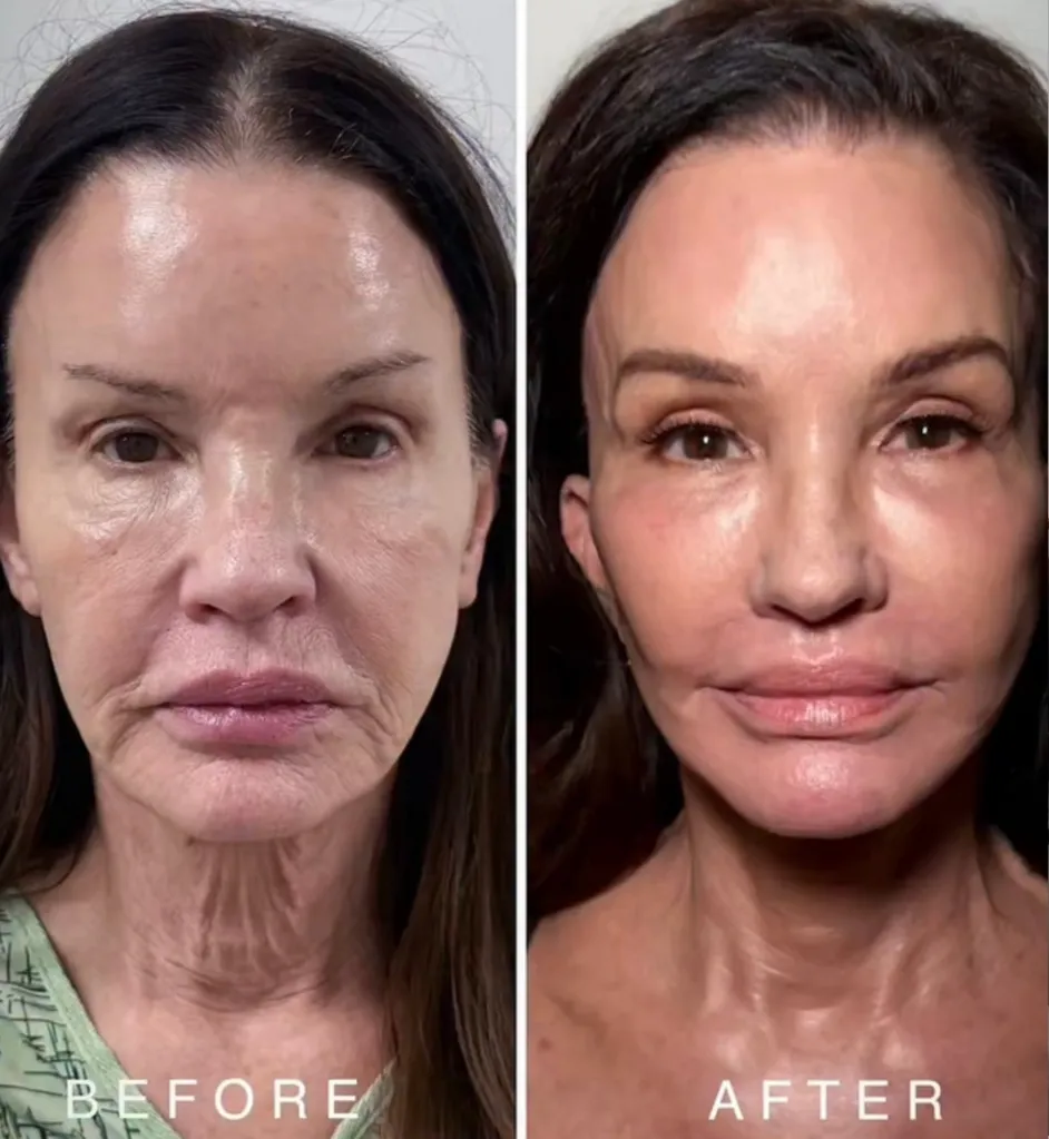 Collage of Janice Dickinson before and after several cosmetic facial procedures.