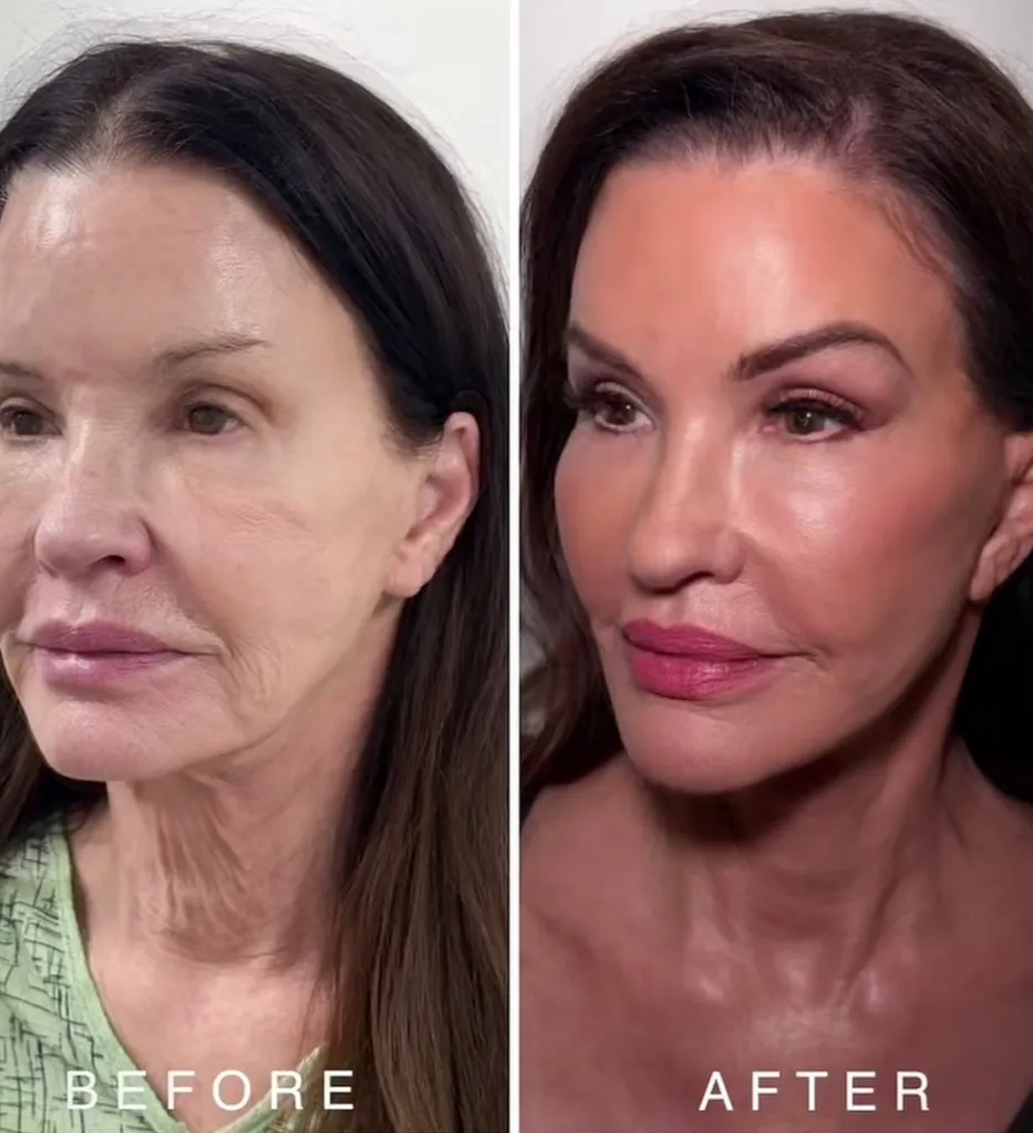 Collage of supermodel Janice Dickinson before and after cosmetic facial procedures.
