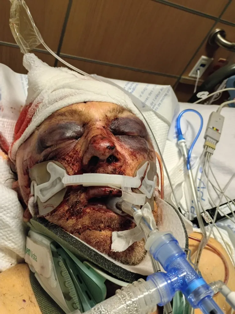 Kerry Sheron in a hospital bed with severe facial injuries and medical tubing.