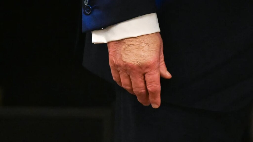 Observers point out Trump’s bruised hands during his health care affordability event