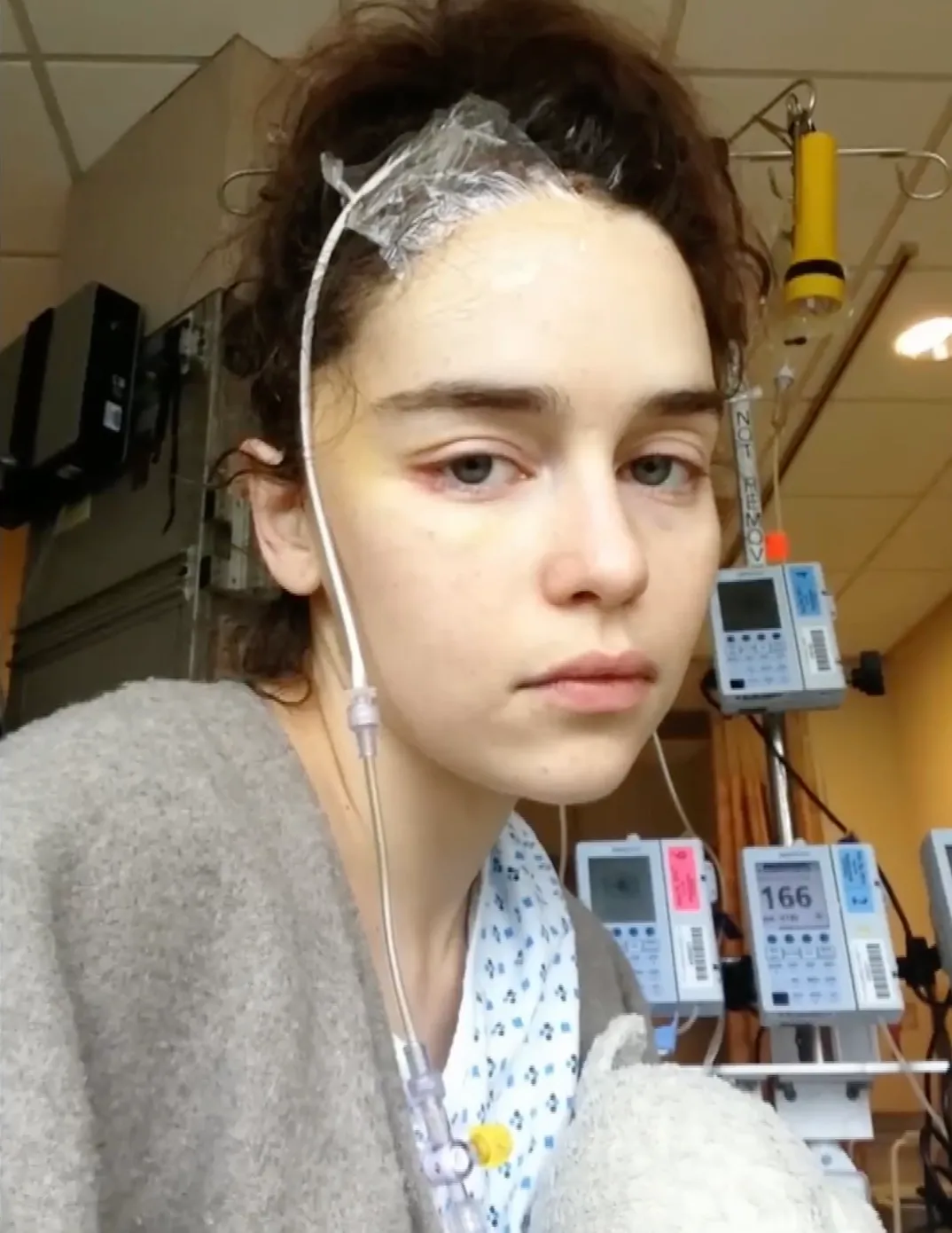 Emilia Clarke recovering in a hospital bed with medical tubes taped to her head.