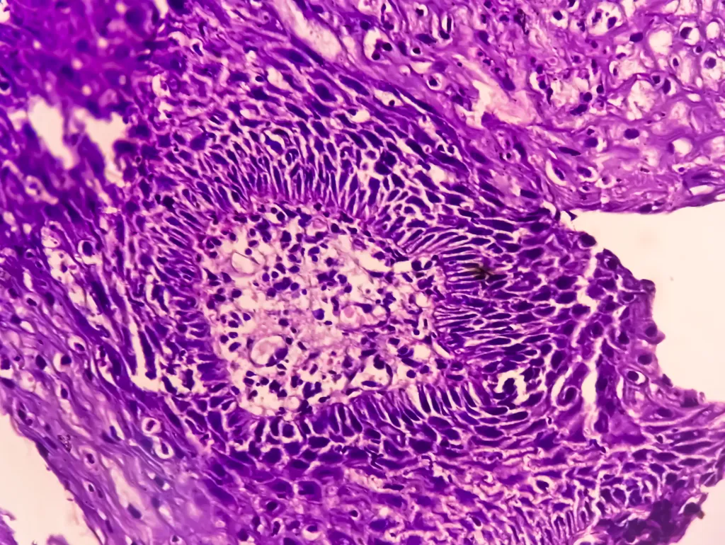 During the follow-up period, 876 people developed stomach cancer and 215 people developed esophageal adenocarcinoma, which is cancer of the tube connecting the mouth to the stomach.