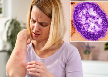Measles emerges in California wastewater as health experts sound alarm