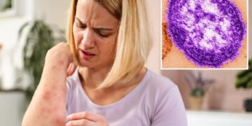 Measles emerges in California wastewater as health experts sound alarm