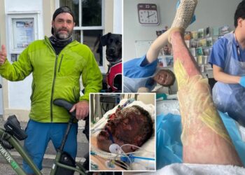 Dad survives five week coma after ‘fireball’ explosion while making gin