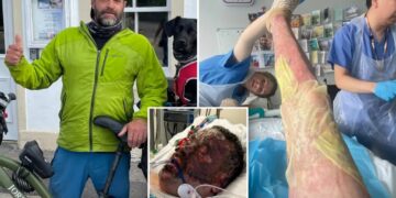 Dad survives five week coma after ‘fireball’ explosion while making gin