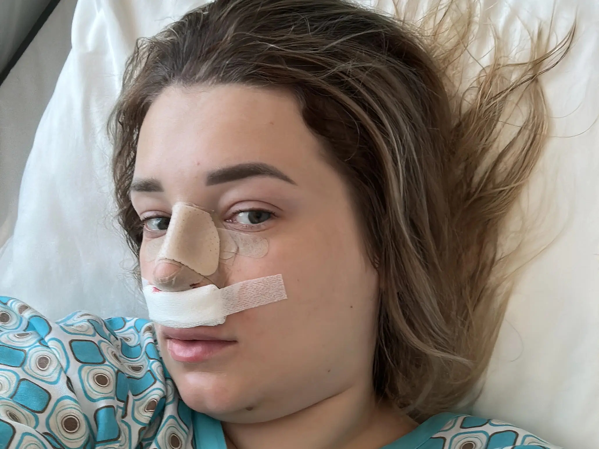 A woman in a hospital bed after a rhinoplasty.