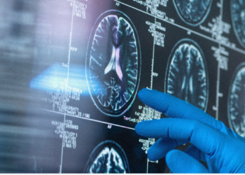 A Woman With Alzheimer’s Spoke in Full Sentences After Taking Psilocybin, Case Study Says