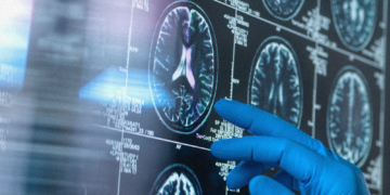 A Woman With Alzheimer’s Spoke in Full Sentences After Taking Psilocybin, Case Study Says