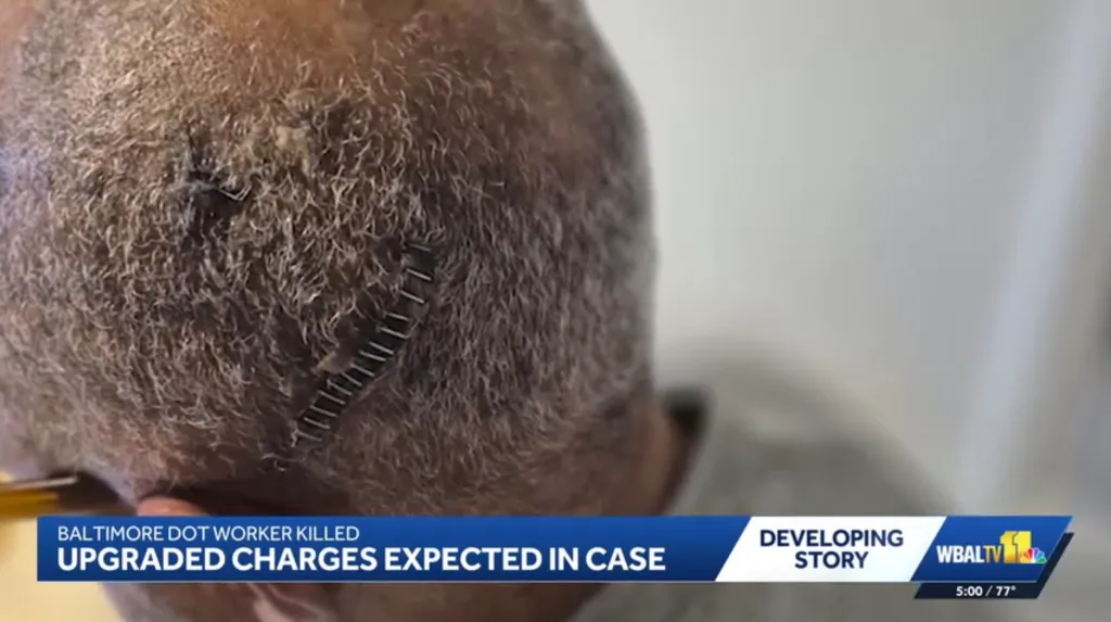 A man's head with staples on his scalp from a recent injury, with a news chyron in the foreground.