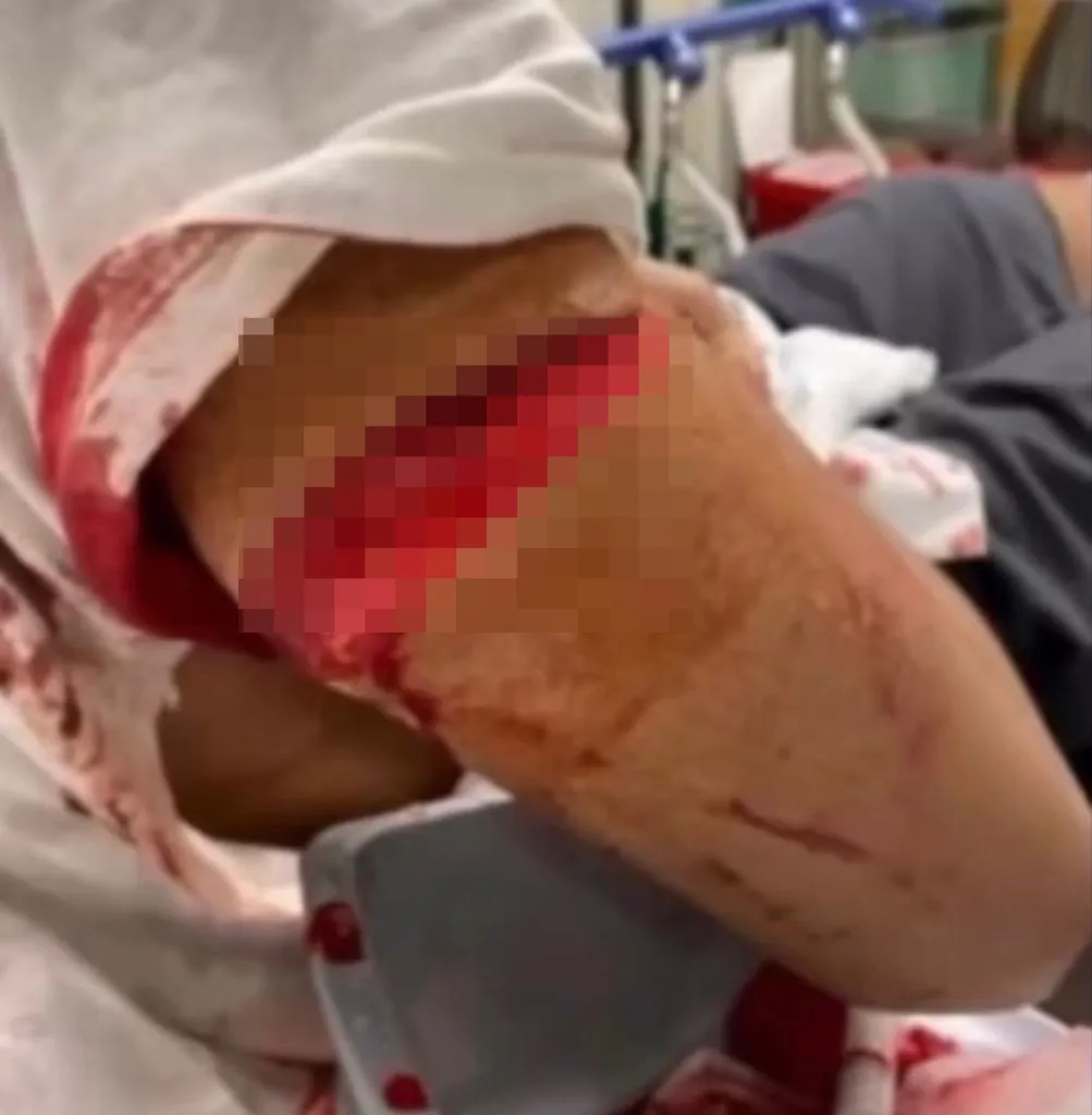Injuries, including a large red gash, on a person's arm after a riot at Horizon Juvenile Center.