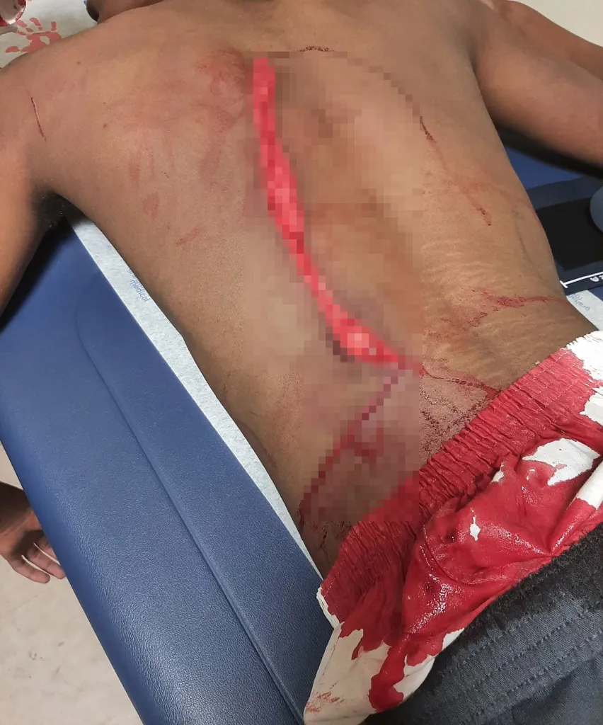 A person on a blue medical table with bloodied clothes and a partially pixelated, large red gash across their torso, from the chest to the hip.