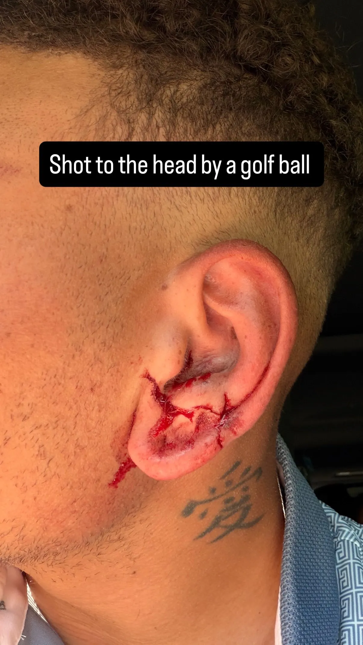 A close-up photo shows Kane Brown's injured ear, with a cut and blood from being hit by a golf ball.