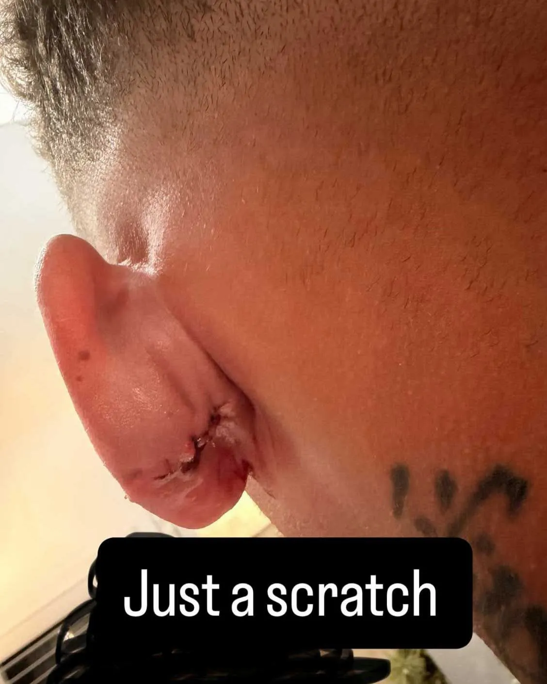 Kane Brown's ear after a golf ball accident, with the caption 