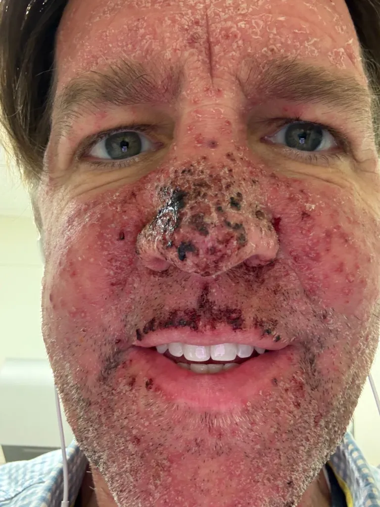 Close-up photo of a man's face covered in red, flaky skin and scabs, especially on his nose and around his mouth.