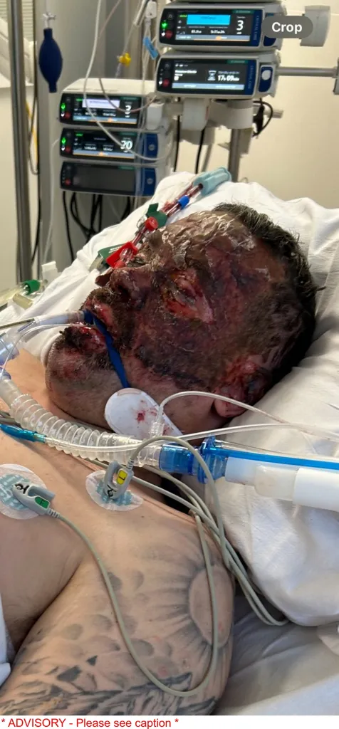 Man with severe facial burns in a hospital bed, attached to medical equipment.