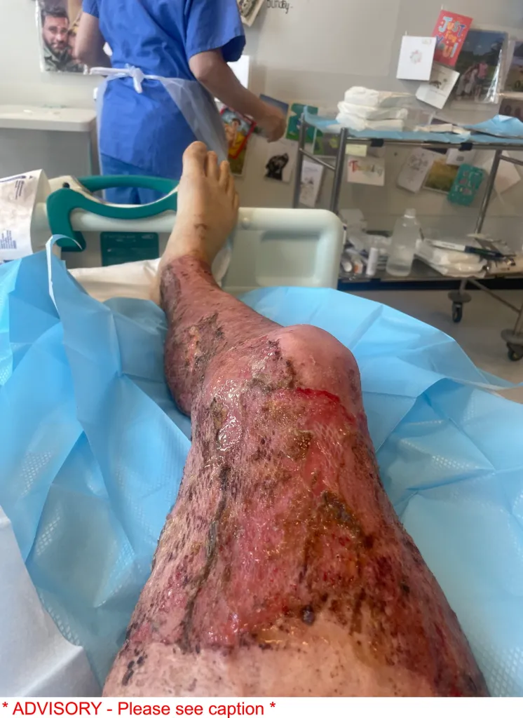 A patient's leg, severely burned and scarred, with visible skin grafts, rests on a hospital bed covered in blue medical drapes, with hospital staff in the background.
