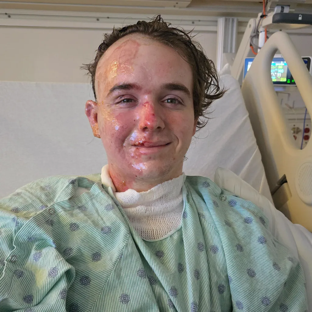 Jacob Smith, a McDonald's worker, in a hospital bed with severe burns on his face and neck after being assaulted by a coworker.