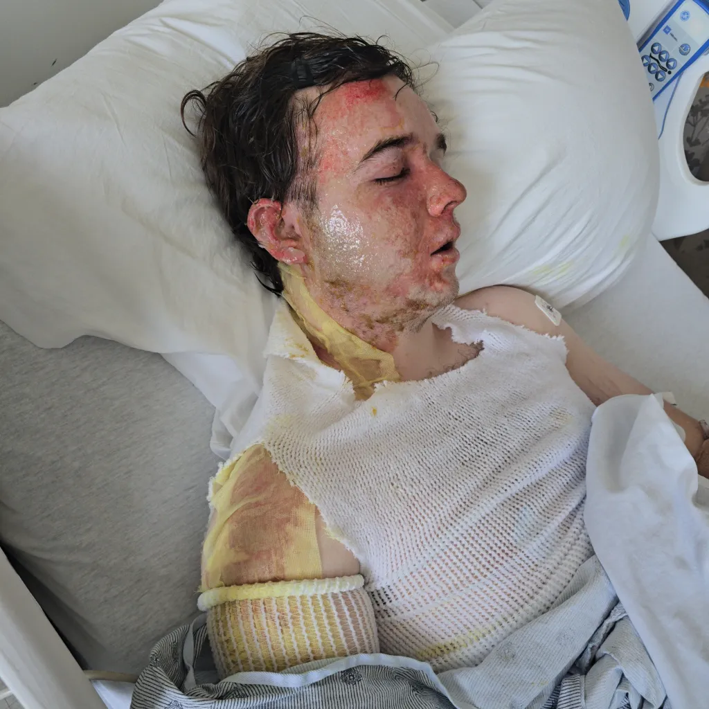 Jacob Smith in a hospital bed with severe burns on his face and body, wrapped in bandages.