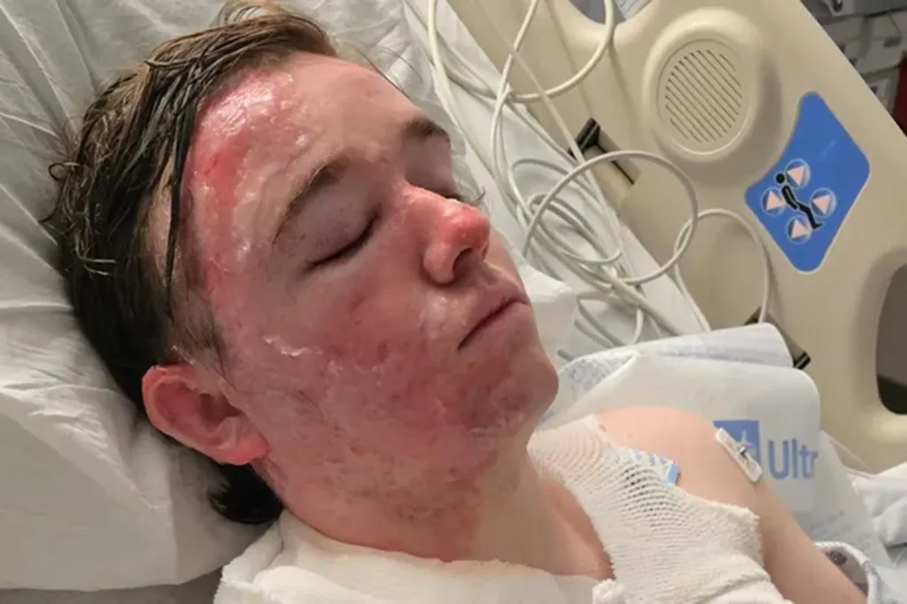 Jacob Smith, a McDonald's worker, in a hospital bed with severe burns on his face after a coworker threw hot oil on him.