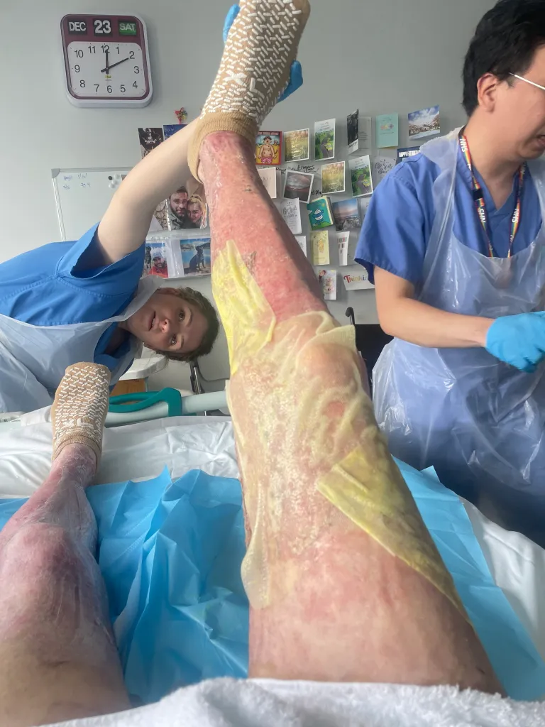 Leigh Taylor in hospital after a gin distillery explosion, showing his burnt legs being cared for by two nurses.